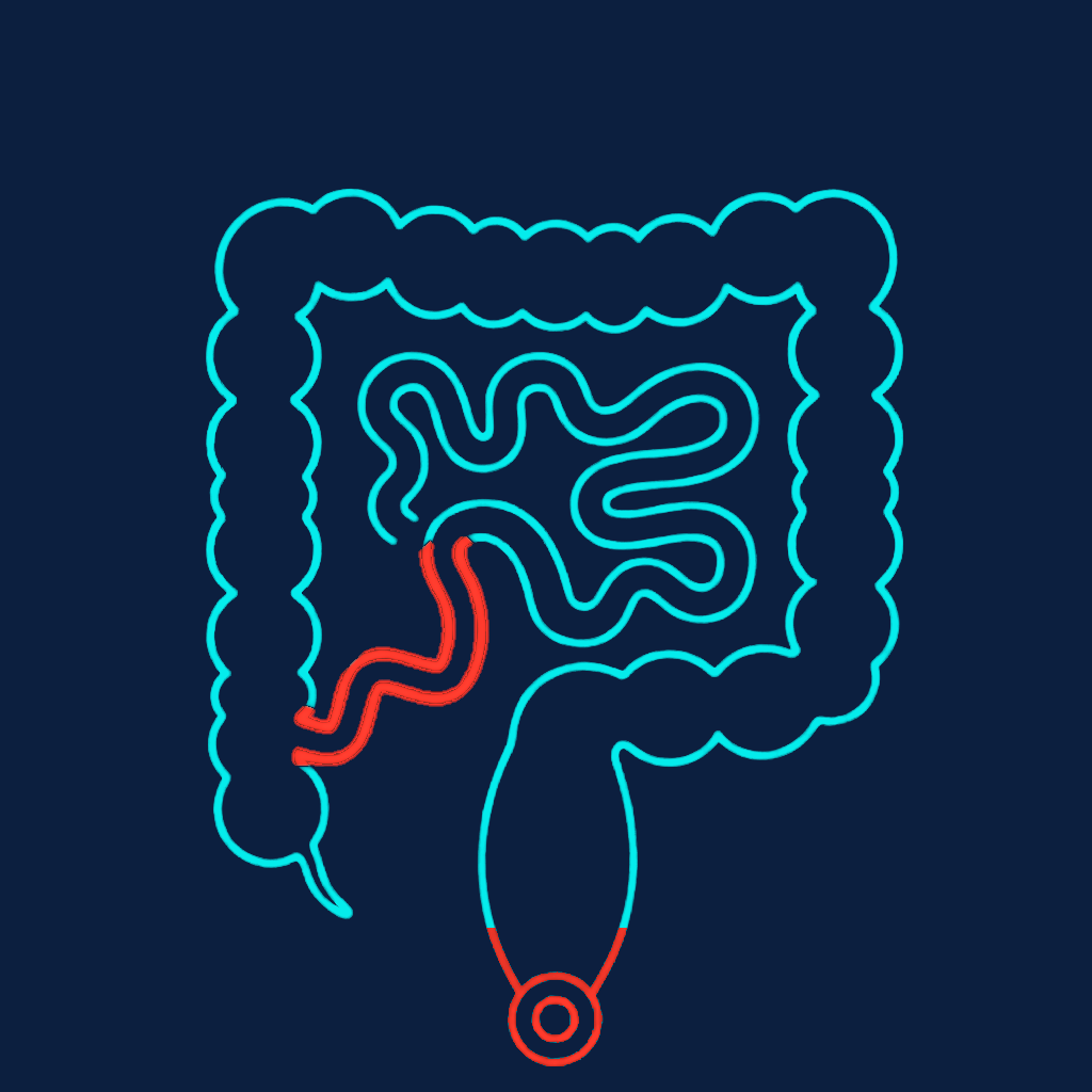 Illustration of perianal Crohn's disease with terminal ileal involvement — red terminal ileum and anal canal
