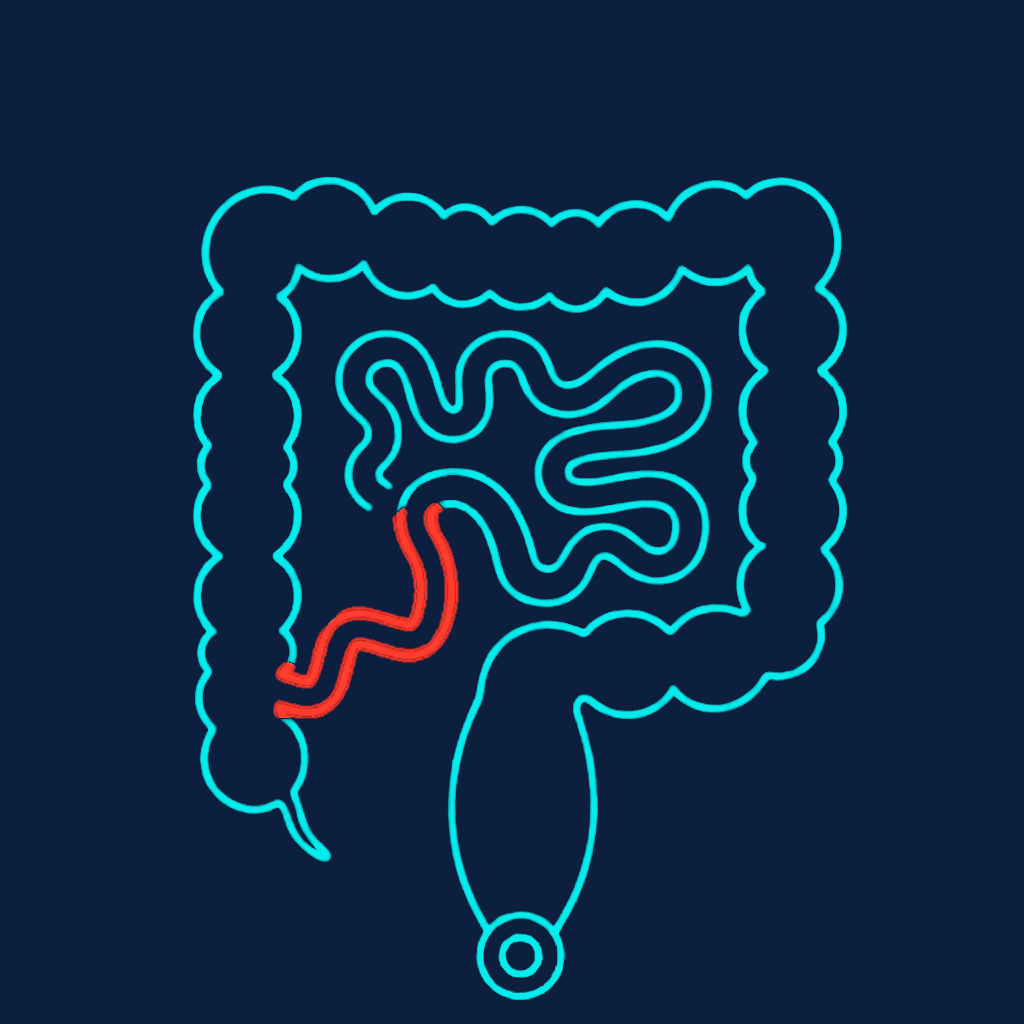 Illustration of ileocolic Crohn's disease — terminal ileum and cecum